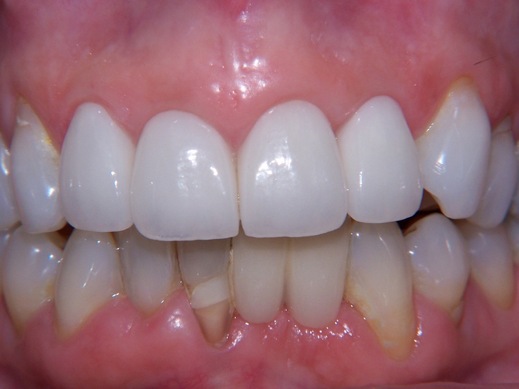 Guest 2: Patient did not like appearance of front teeth. Four all ceramic crowns were placed. 