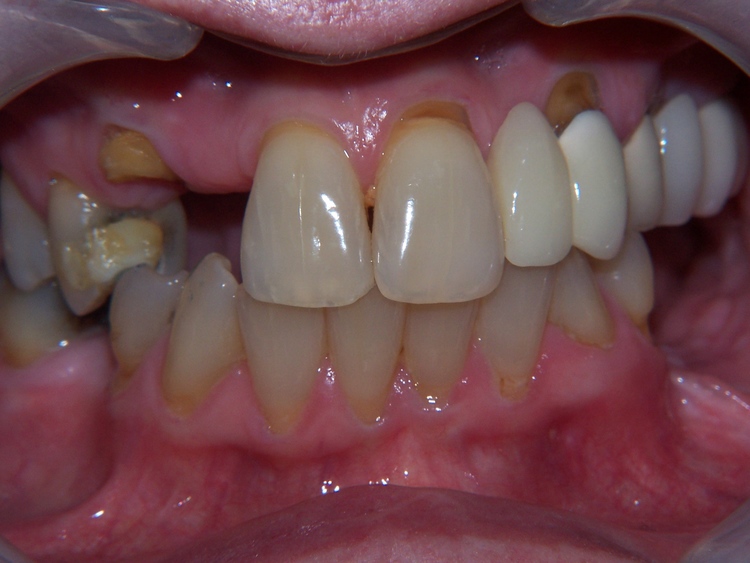 Guest 3: Full mouth reconstruction including implants, crowns, and bridgework.